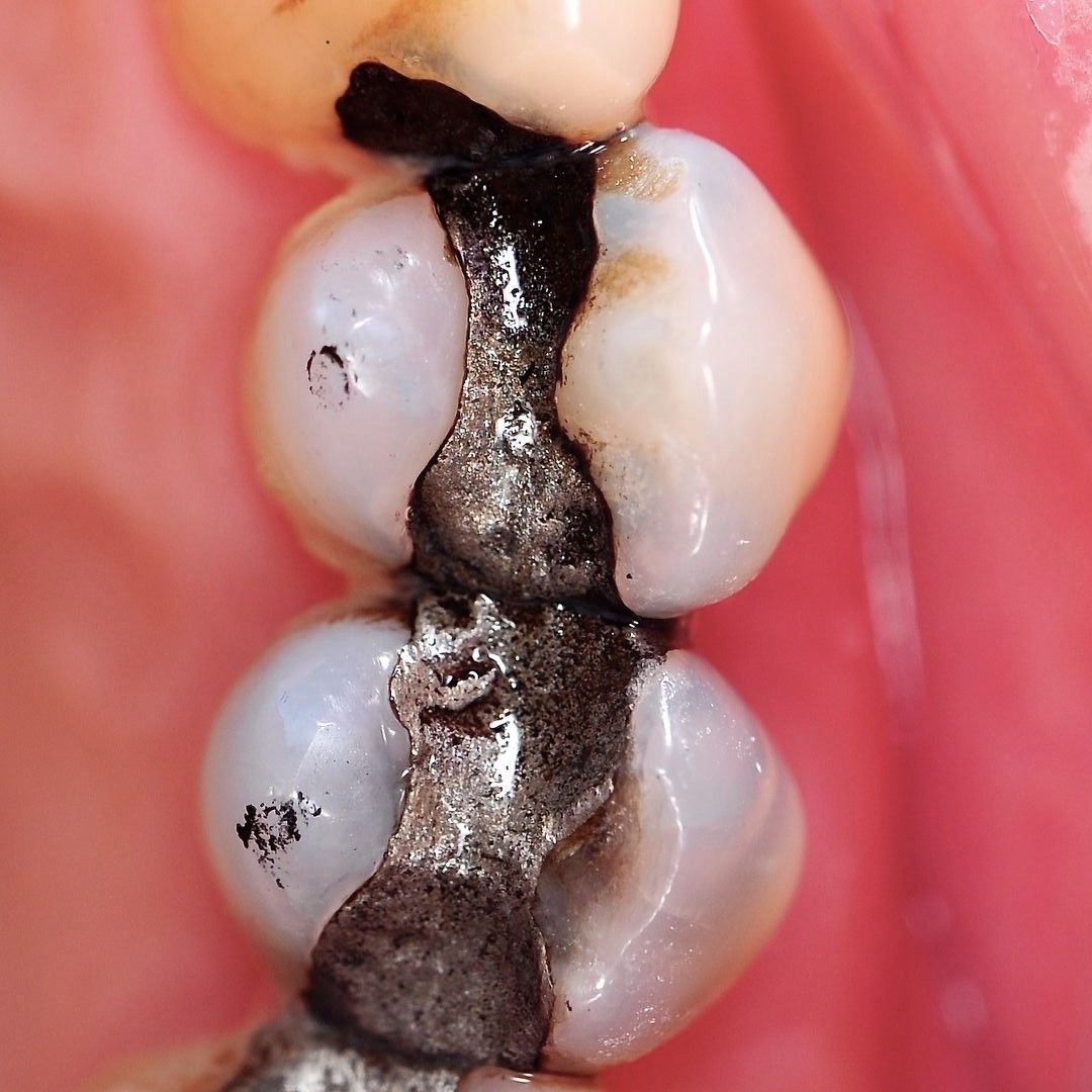 Back Tooth Filling Restoration before