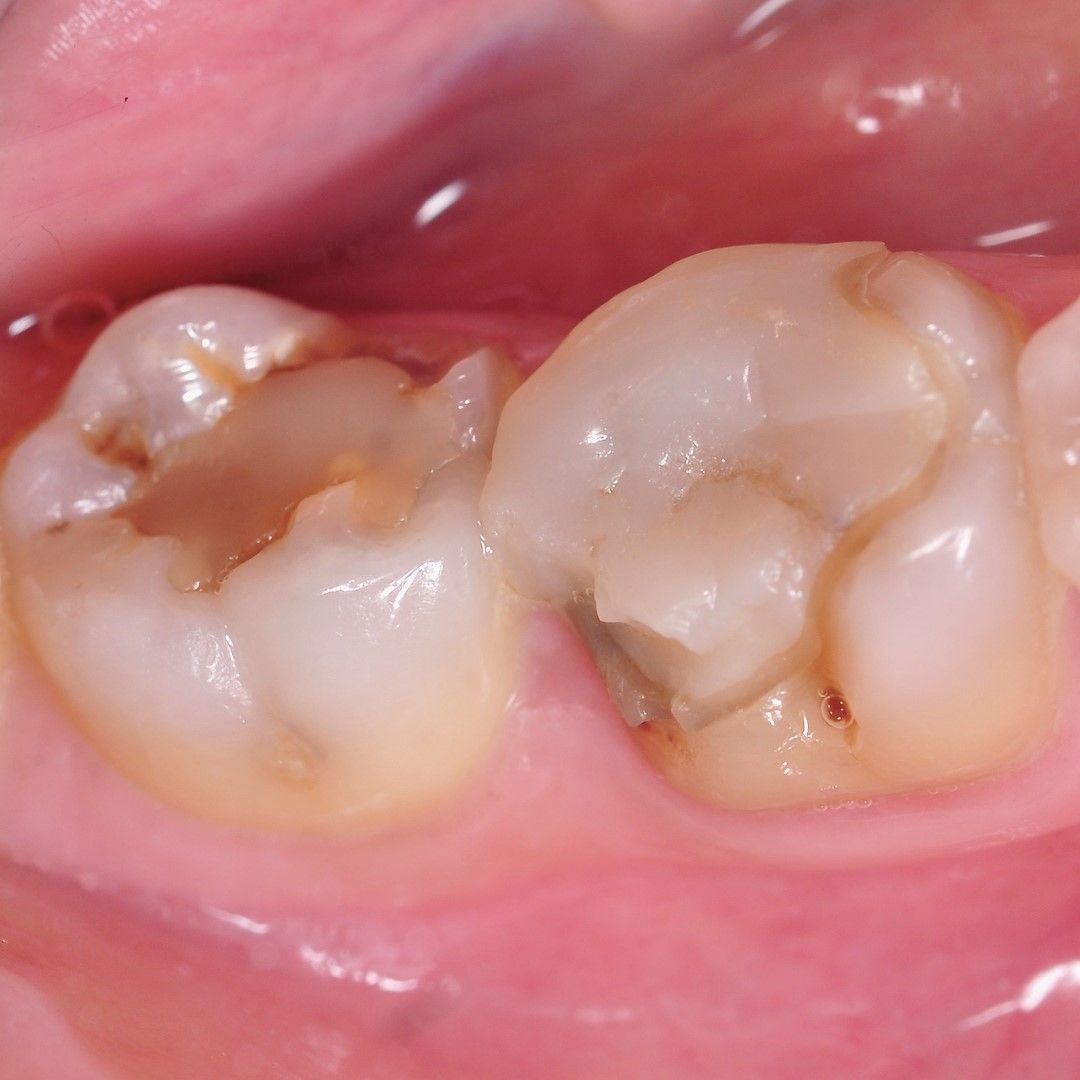 Back Teeth Repair of Grinding Fractures before
