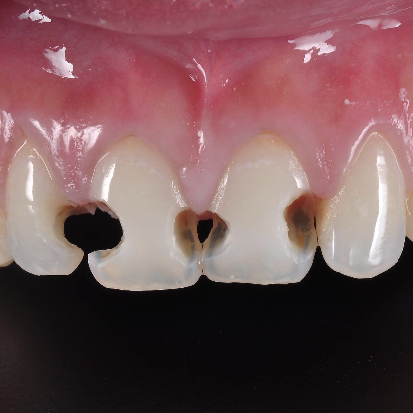 Broken Fillings Makeover before