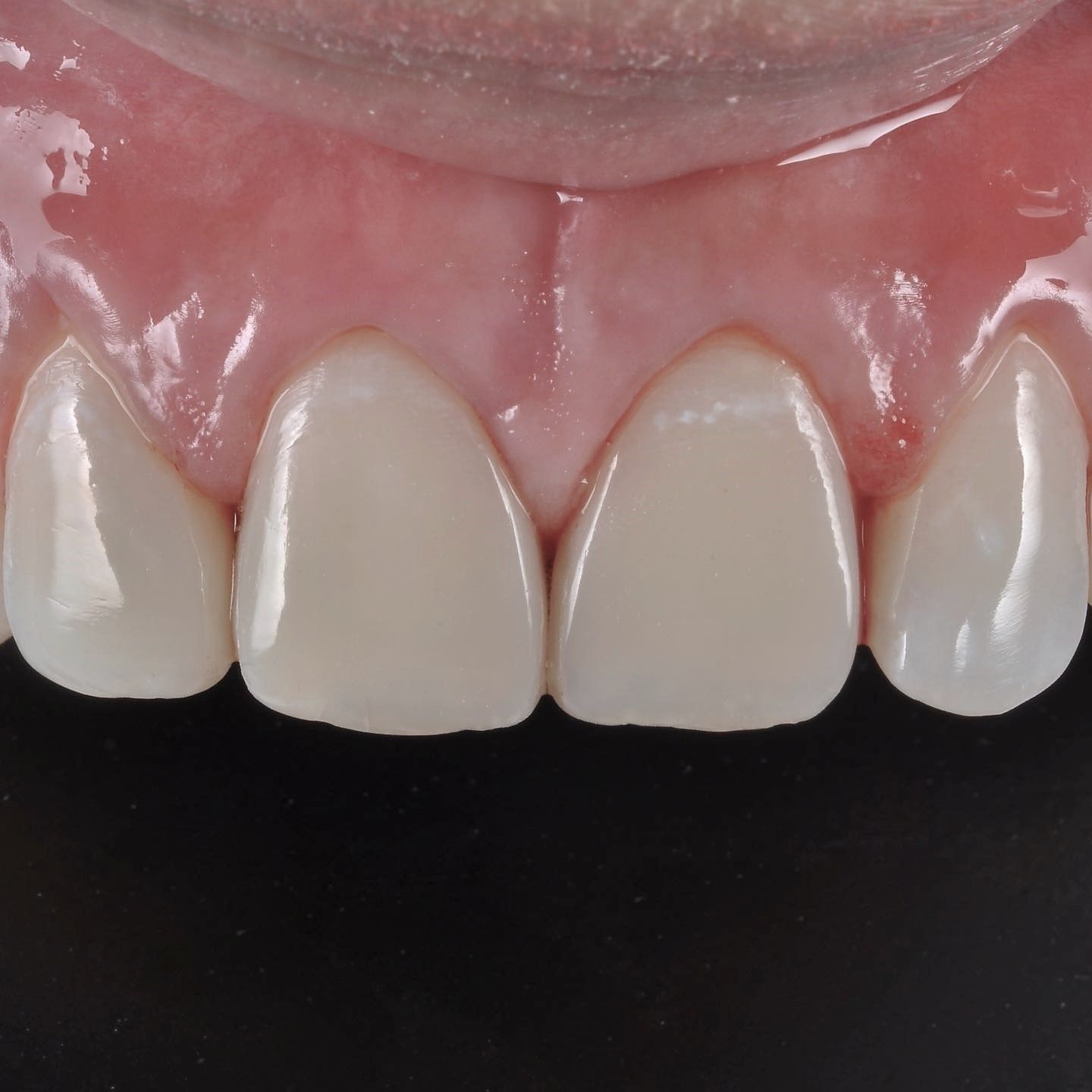 Broken Fillings Makeover after