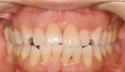 Invisalign before